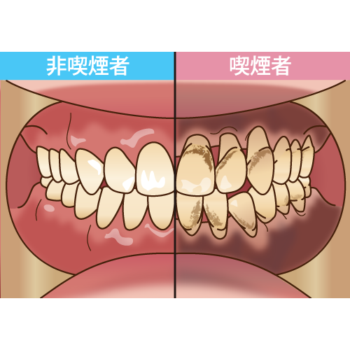 喫煙が口腔内に与える影響について | 総合歯科HMクリニック